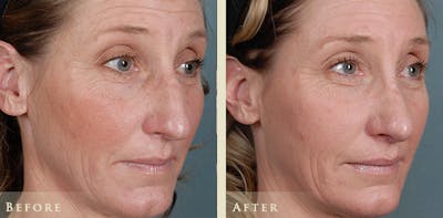 Aesthetic Rhinoplasty Before & After Gallery - Patient 333665 - Image 2