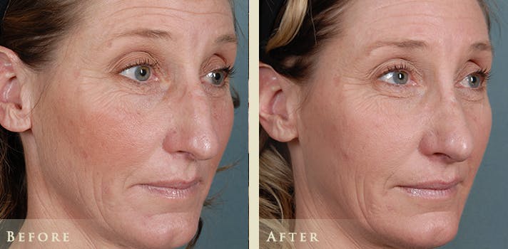 Aesthetic Rhinoplasty Before & After Gallery - Patient 333665 - Image 2