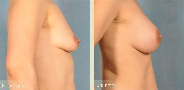 Mommy Makeover Before & After Gallery - Patient 255264 - Image 1