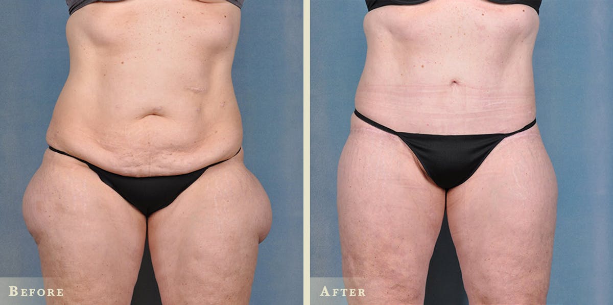 Body Lift Before & After Gallery - Patient 343562 - Image 1