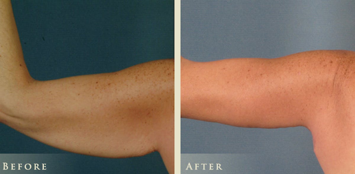 Arm Lift Before & After Gallery - Patient 172004 - Image 1