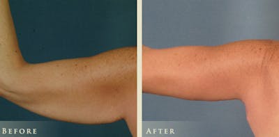 Arm Lift Before & After Gallery - Patient 172004 - Image 1