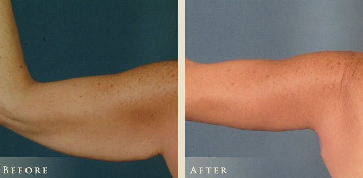 Arm Lift Before & After Gallery - Patient 172004 - Image 1