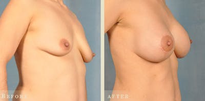 Mommy Makeover Before & After Gallery - Patient 255264 - Image 2