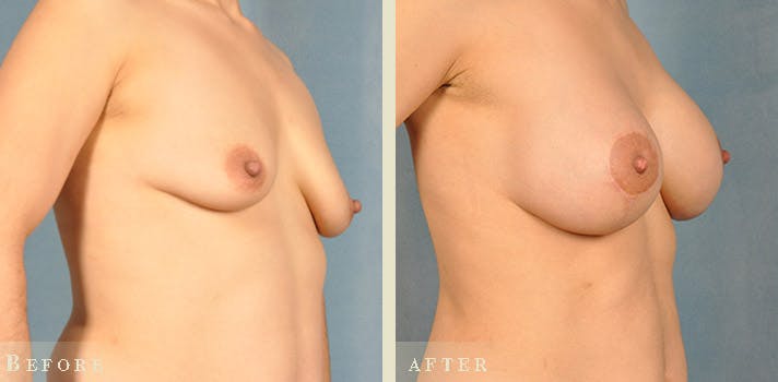 Mommy Makeover Before & After Gallery - Patient 255264 - Image 2