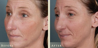 Aesthetic Rhinoplasty Before & After Gallery - Patient 333665 - Image 3