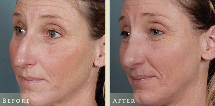 Aesthetic Rhinoplasty Before & After Gallery - Patient 333665 - Image 3
