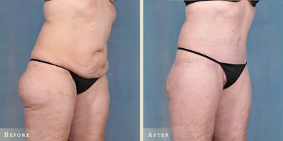 Body Lift Before & After Gallery - Patient 343562 - Image 2