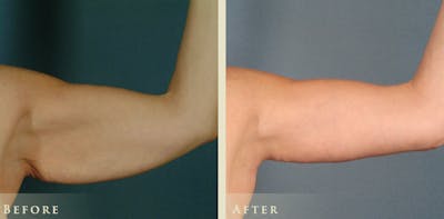Arm Lift Before & After Gallery - Patient 172004 - Image 2