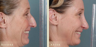 Aesthetic Rhinoplasty Before & After Gallery - Patient 333665 - Image 4