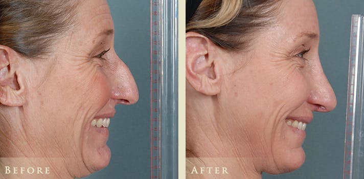Aesthetic Rhinoplasty Before & After Gallery - Patient 333665 - Image 4