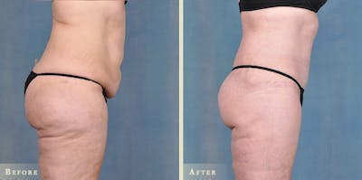 Body Lift Before & After Gallery - Patient 343562 - Image 3