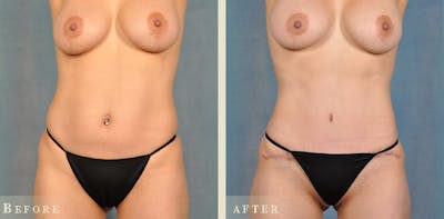 Mommy Makeover Before & After Gallery - Patient 255264 - Image 4
