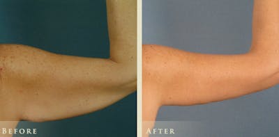Arm Lift Before & After Gallery - Patient 172004 - Image 3