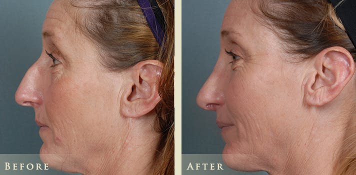 Aesthetic Rhinoplasty Before & After Gallery - Patient 333665 - Image 5