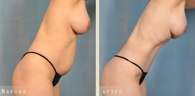 Mommy Makeover Before & After Gallery - Patient 255264 - Image 5