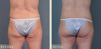 Body Lift Before & After Gallery - Patient 302246 - Image 1