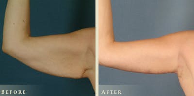 Arm Lift Before & After Gallery - Patient 172004 - Image 4