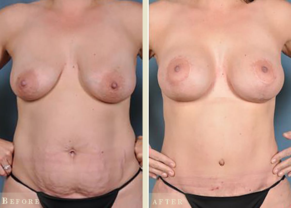 Mommy Makeover Before & After Gallery - Patient 844359 - Image 1