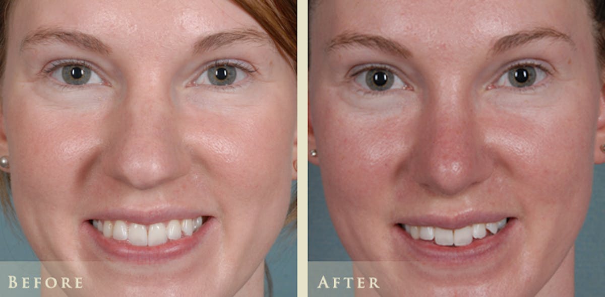 Aesthetic Rhinoplasty Before & After Gallery - Patient 320699 - Image 1