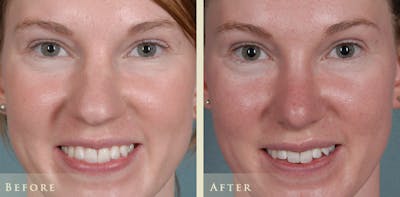 Aesthetic Rhinoplasty Before & After Gallery - Patient 320699 - Image 1