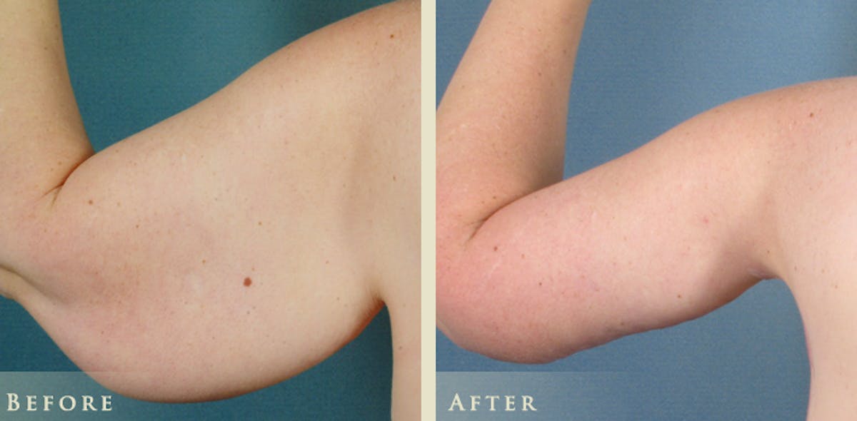Arm Lift Before & After Gallery - Patient 344526 - Image 1