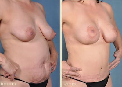 Mommy Makeover Before & After Gallery - Patient 844359 - Image 2