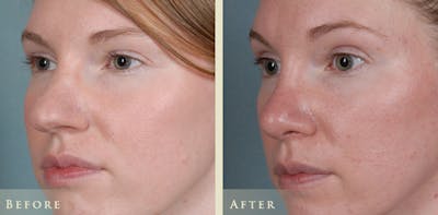 Aesthetic Rhinoplasty Before & After Gallery - Patient 320699 - Image 2