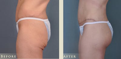 Body Lift Before & After Gallery - Patient 302246 - Image 3