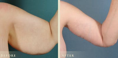Arm Lift Before & After Gallery - Patient 344526 - Image 2