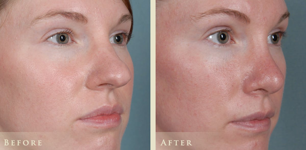 Aesthetic Rhinoplasty Before & After Gallery - Patient 320699 - Image 3