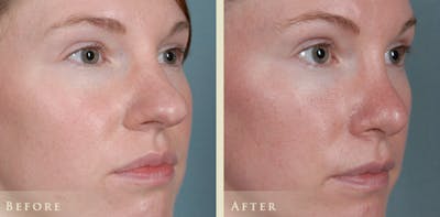 Aesthetic Rhinoplasty Before & After Gallery - Patient 320699 - Image 3