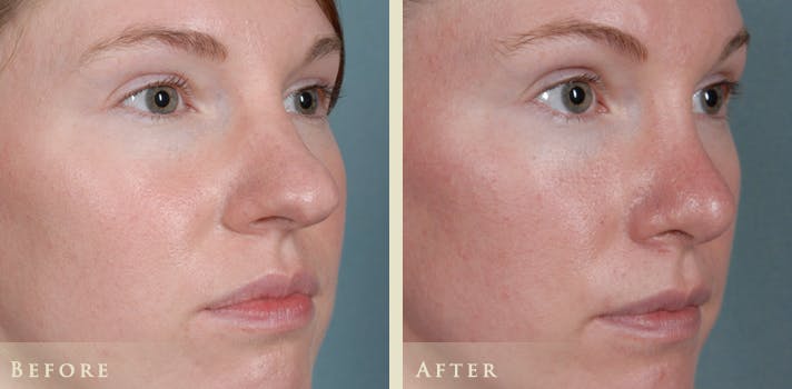 Aesthetic Rhinoplasty Before & After Gallery - Patient 320699 - Image 3
