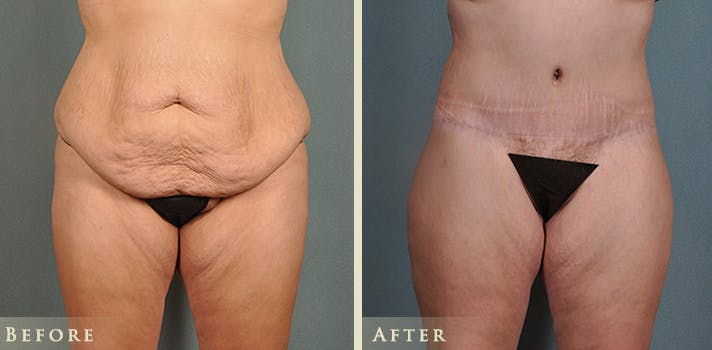 Body Lift Before & After Gallery - Patient 186158 - Image 1