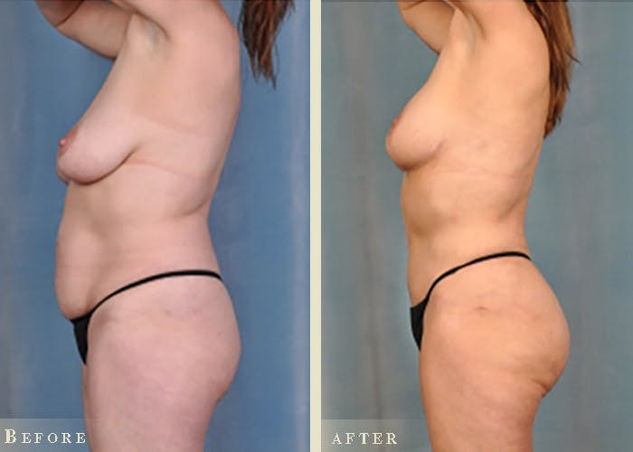 Mommy Makeover Before & After Gallery - Patient 327260 - Image 1