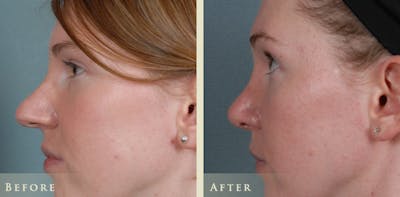 Aesthetic Rhinoplasty Before & After Gallery - Patient 320699 - Image 4