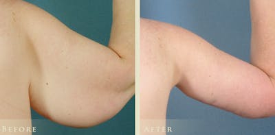Arm Lift Before & After Gallery - Patient 344526 - Image 3