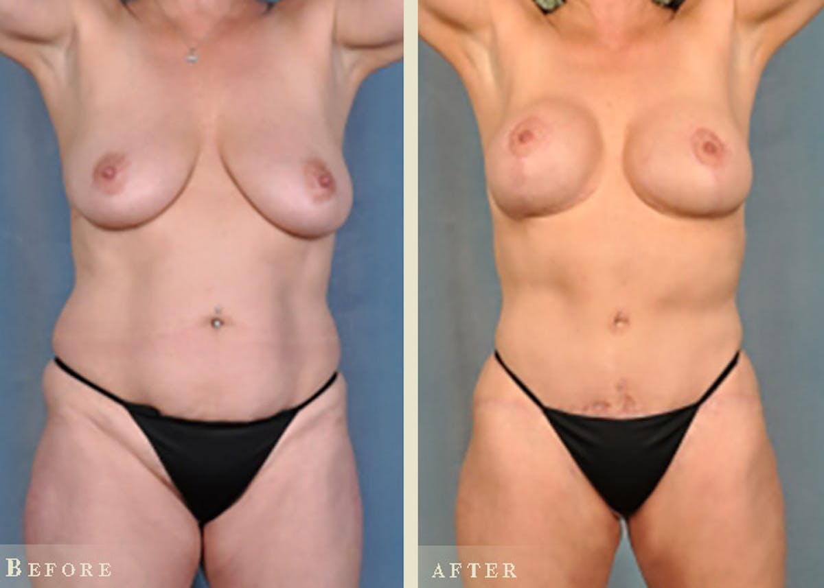 Mommy Makeover Before & After Gallery - Patient 327260 - Image 2