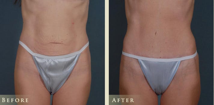 Mini Tummy Tuck Before & After Gallery - Patient 285382 - Image 1