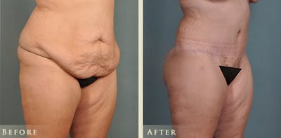 Body Lift Before & After Gallery - Patient 186158 - Image 2