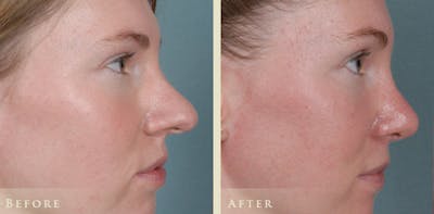 Aesthetic Rhinoplasty Before & After Gallery - Patient 320699 - Image 5