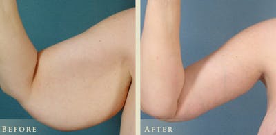 Arm Lift Before & After Gallery - Patient 344526 - Image 4