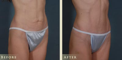 Mini Tummy Tuck Before & After Gallery - Patient 285382 - Image 2