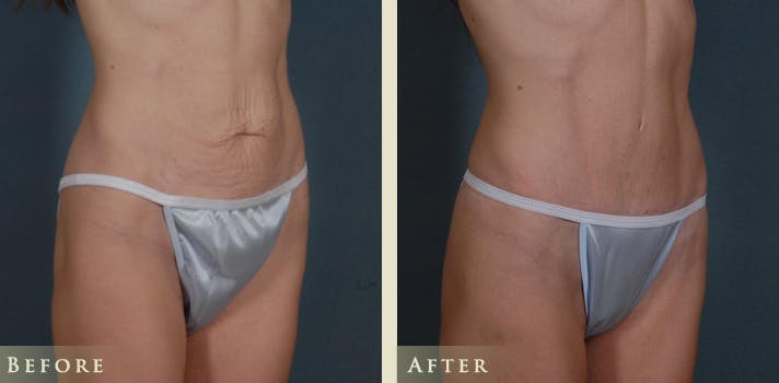 Mini Tummy Tuck Before & After Gallery - Patient 285382 - Image 2