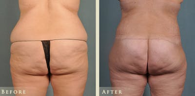 Body Lift Before & After Gallery - Patient 186158 - Image 3