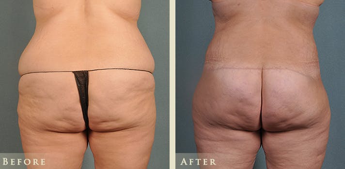 Body Lift Before & After Gallery - Patient 186158 - Image 3