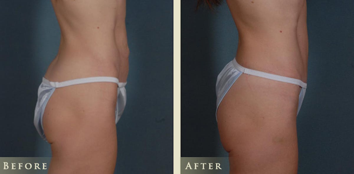 Mini Tummy Tuck Before & After Gallery - Patient 285382 - Image 3
