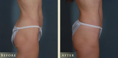 Mini Tummy Tuck Before & After Gallery - Patient 285382 - Image 3