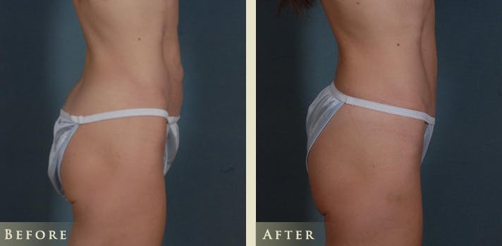 Mini Tummy Tuck Before & After Gallery - Patient 285382 - Image 3