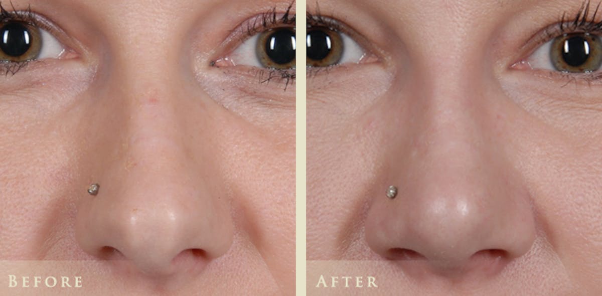 Aesthetic Rhinoplasty Before & After Gallery - Patient 453265 - Image 1